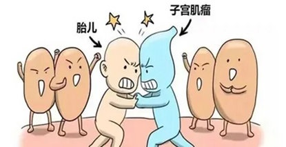 当怀孕遇上子宫肌瘤，宝妈怎样成功闯关！