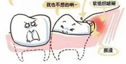 智齿：人类进化中的bug，不疼不拔真的对吗？