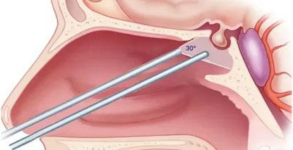 颅内“小不点儿”引发妇科大问题？